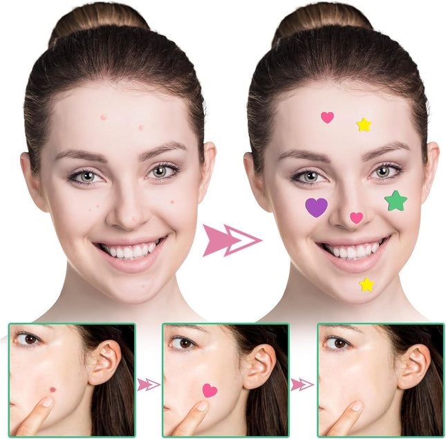 Acne Patch Pimple Patch,Pink Heart & Star Shaped Acne Absorbing Spot Patches, Hydrocolloid Acne Patches for Face Zit Patch Acne Dots,156 Patches Tea Tree Oil Centella Body Blemish Skin Care