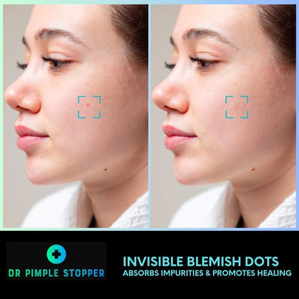 Acne Spot Patches Pack of 24 Translucent Hydrocolloid Infused with Centella Asiatic Oil Patch Spot Treatment Stickers for Face and Body - Fast-Acting, Invisible Korean Skincare